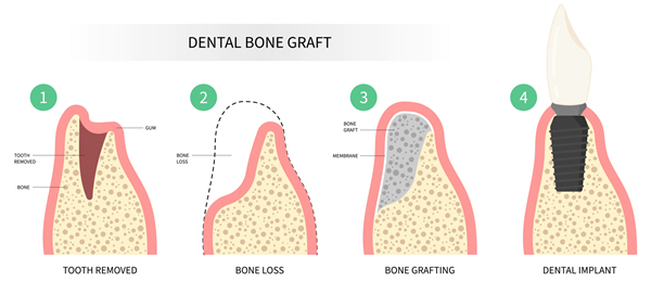 Bone Replacement Grafts at Linglestown Family Dental