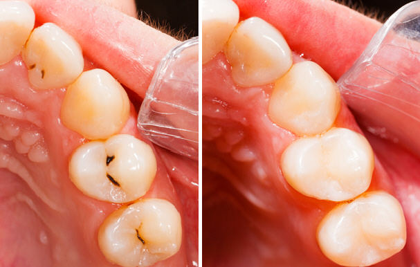 Composite Dental Tooth Colored FIllings at Linglestown Family Dental, Harrisburg, PA