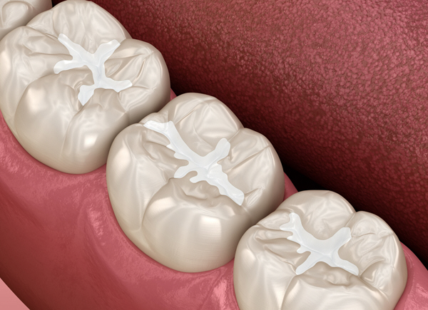 Composite Dental Tooth Colored FIllings at Linglestown Family Dental, Harrisburg, PA