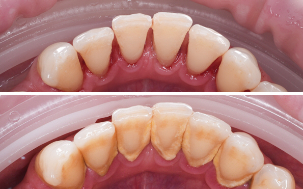 Dental Scaling and Root Planing at Linglestown Family Dental