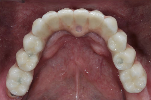 Intraoral