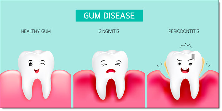 Gum Disease