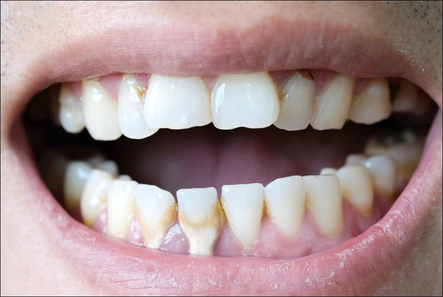 Gum Pain