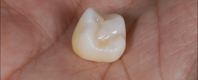 Dental Crown